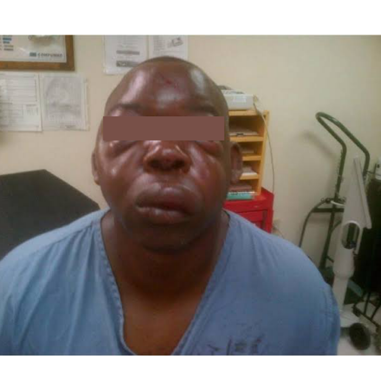 Hypertensive kidney Disease